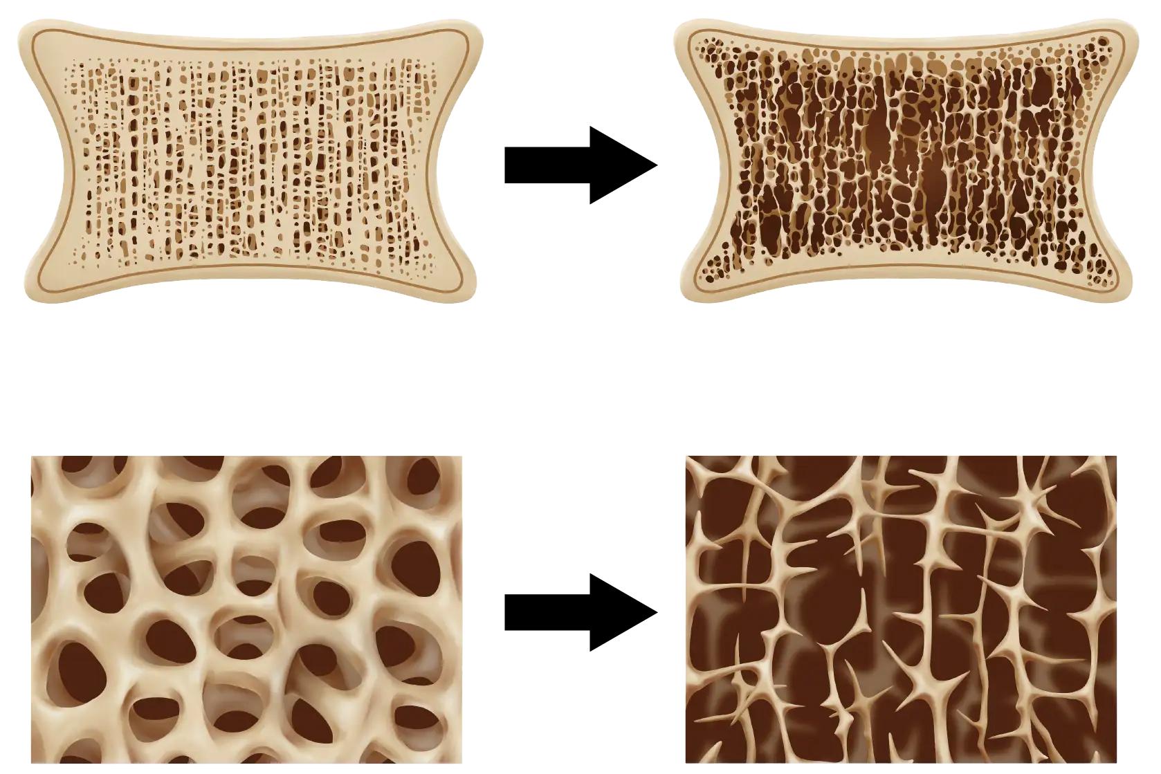 骨粗鬆症の画像