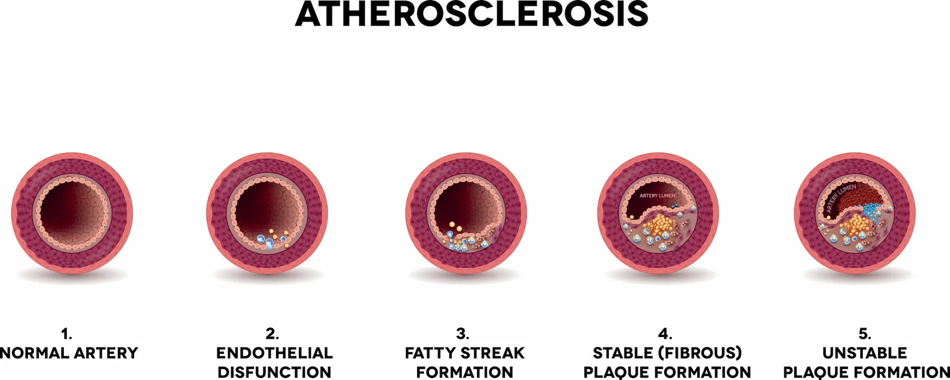 内皮障害から動脈硬化